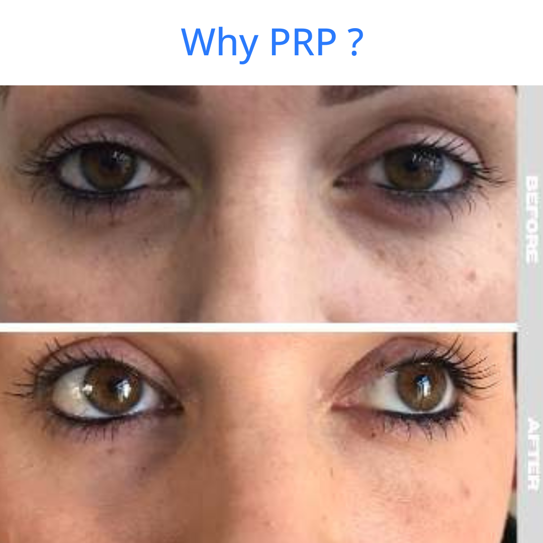 PRP Age Reversal treatment 
