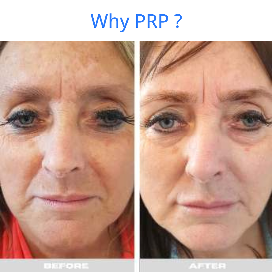 PRP Age Reversal treatment with stem cell therapy